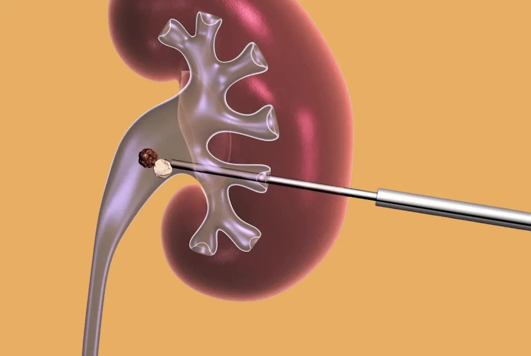 Nefrolitotomía percutánea por mínima invasión